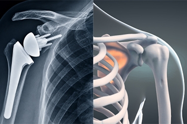 Mako Robotic vs. Traditional Shoulder Replacement: What's the Difference?