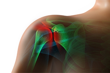 Reducing Infection Risk in Shoulder Replacement: The Role of Betadine Irrigation
