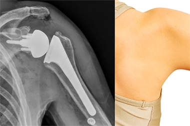 What Is a Reverse Shoulder Replacement - And Why Does Robotic Precision Matter?